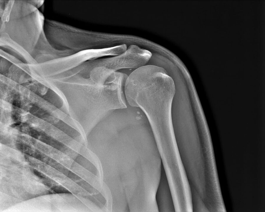 X-ray of grade 2 arthrosis of the shoulder joint