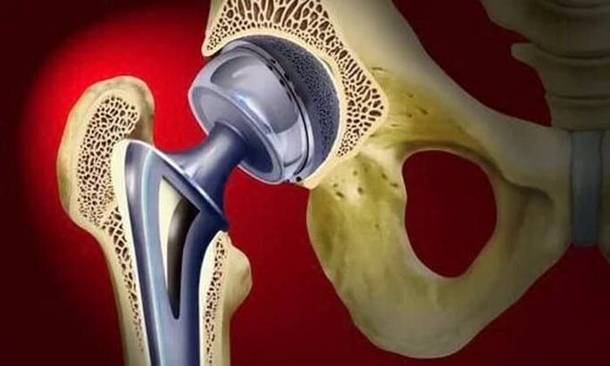 hip replacement in arthrosis
