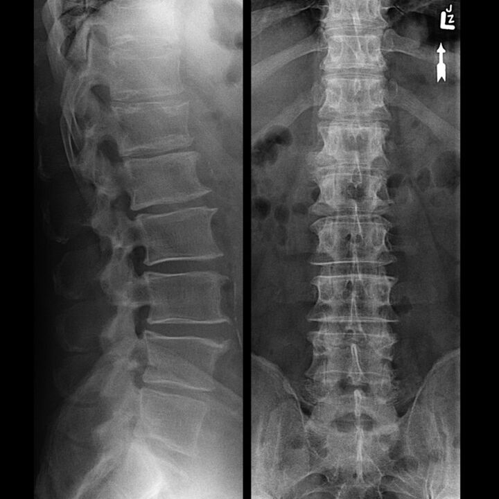 X-ray of the thoracic region showing a reduction in the gap between the vertebrae along the spine from the bottom up