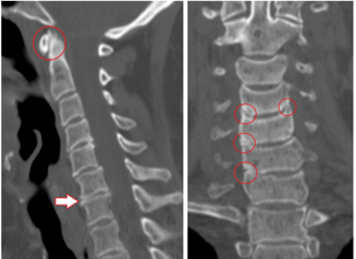 CT scan shows vertebrae and heterogeneous-height plates damaged by chest osteochondrosis