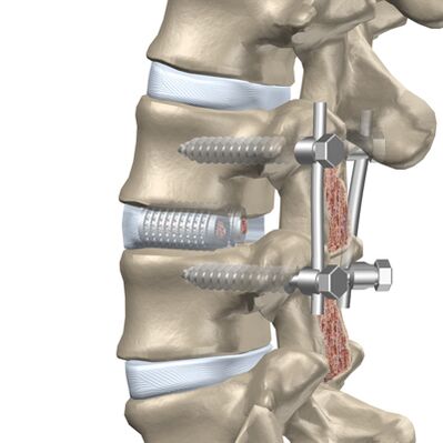 Replacement of a damaged plate in the thoracic spine with an artificial implant