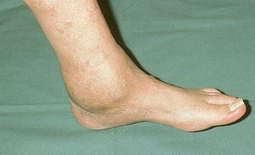the ankle swelling with arthrosis