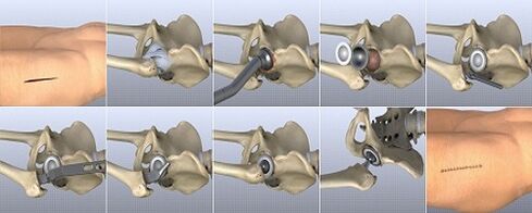Methods of treatment of hip joint arthrosis