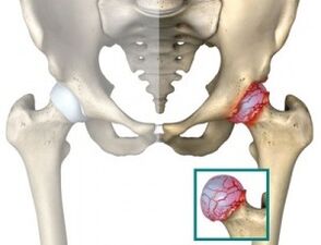 causes of atrophy of the hip joint